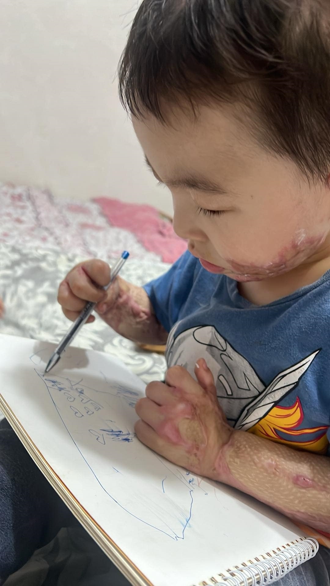 화상으로 구부러진 손가락 펴고 글씨를 쓰고 싶어요!